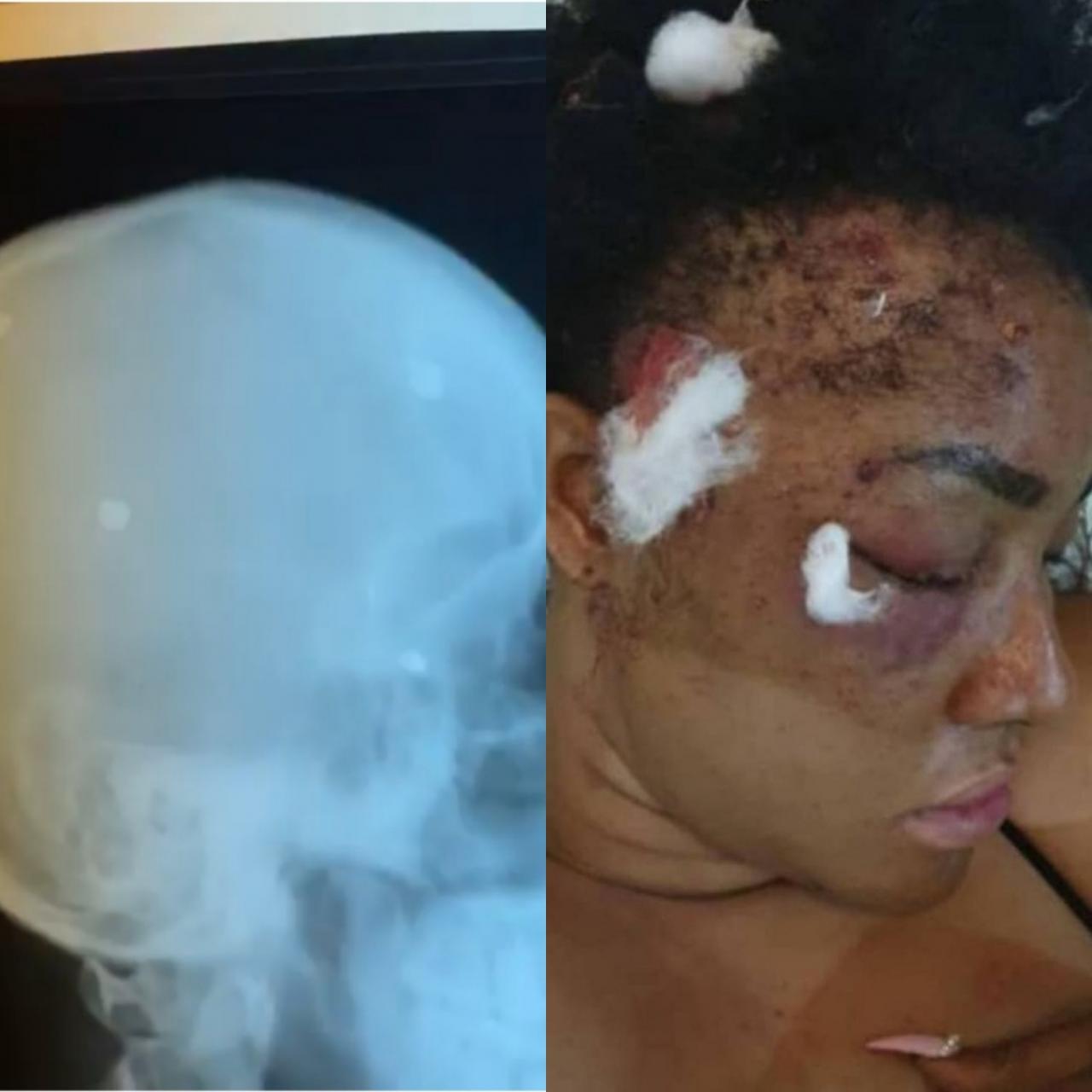 "After 2 years plus, pellets are still coming out" Actress, Angel Okorie shows X-ray of her head years after she was shot (video)