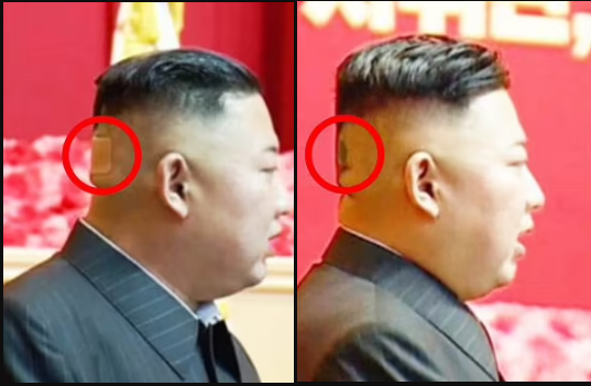 North Korean leader, Kim Jong Un?spotted with plaster on the back of his head and mysterious black spots?in latest health scare (photos)