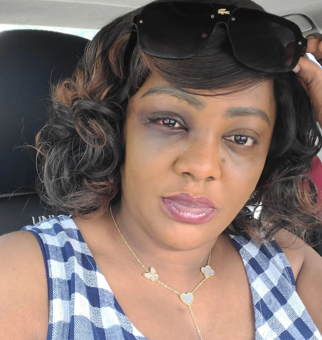 Actress, Helen Paul shares photo of her bruised face as she discloses she was involved in a car accident in Abuja