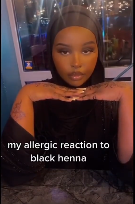 Lady narrates how she had an allergic reaction to a black henna (video)