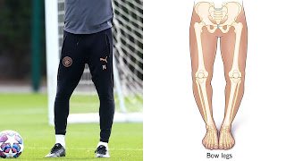 why-footballers-have-bow-leg.jpg